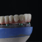 korony-pelnoceramiczne